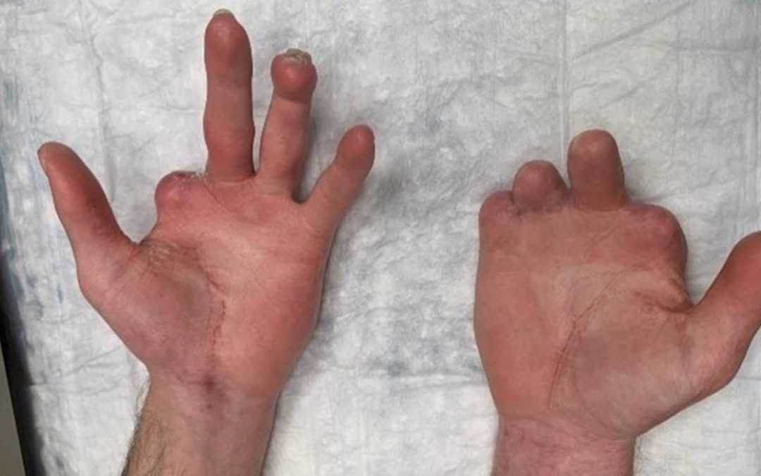 Kroger ordered to pay $75M+ to man who lost part of hands while working at Michigan store