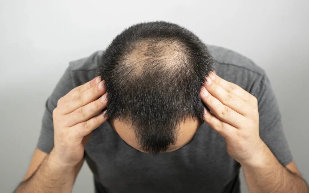 Scientists May Have Accidentally Found a Way to Reverse Hair Loss Without Drugs