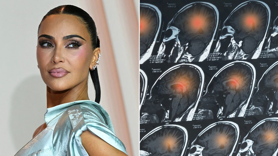 Kim Kardashian’s brain aneurysm scare: Doctors reveal warning signs to never ignore