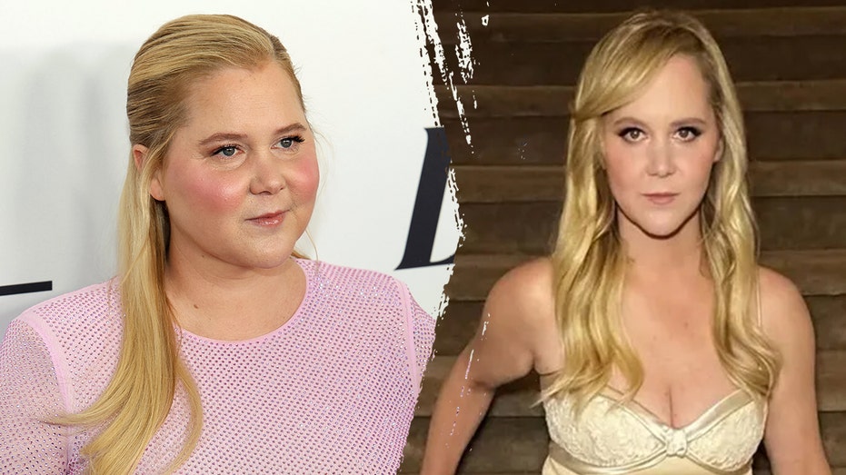 What to know about Cushing’s syndrome, which led to Amy Schumer’s dramatic weight loss